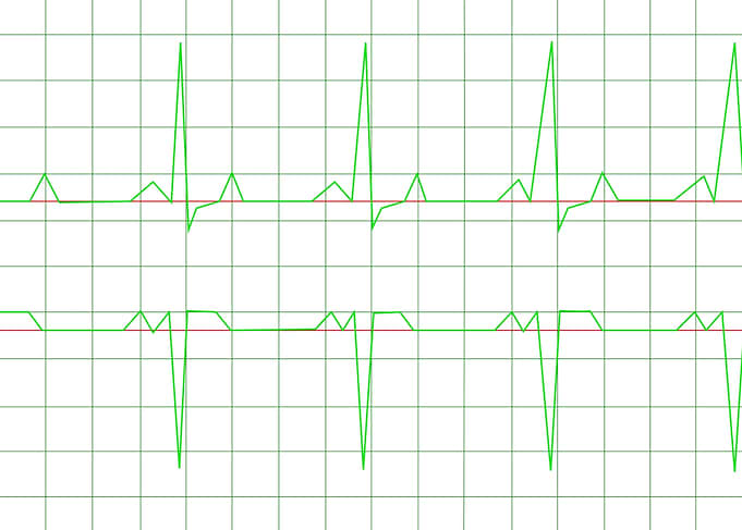 Normal Heart Rhythm Normal Heart Rhythm electrocardiogr ...