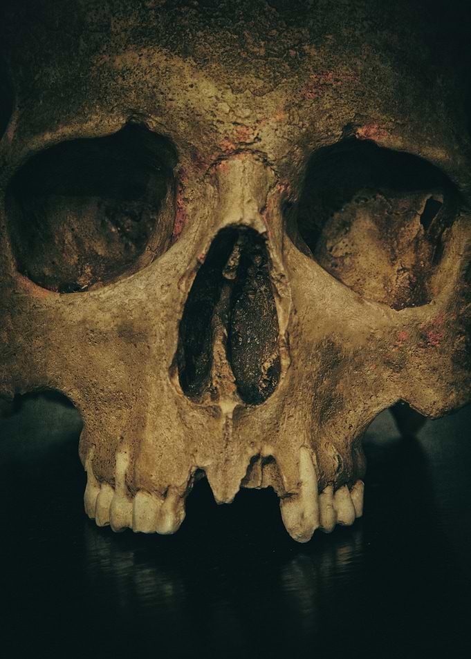 Male skull with missing teeth