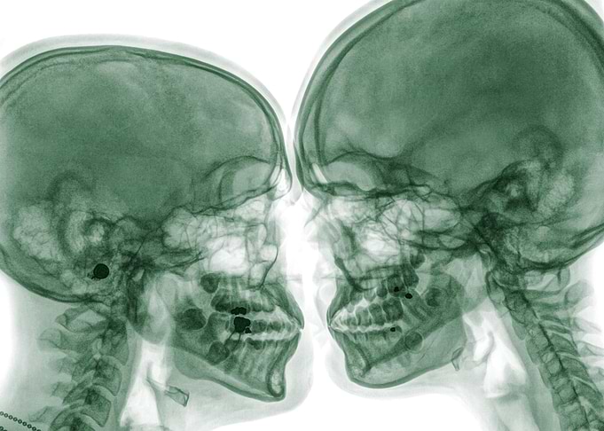 Kissing Couple x ray