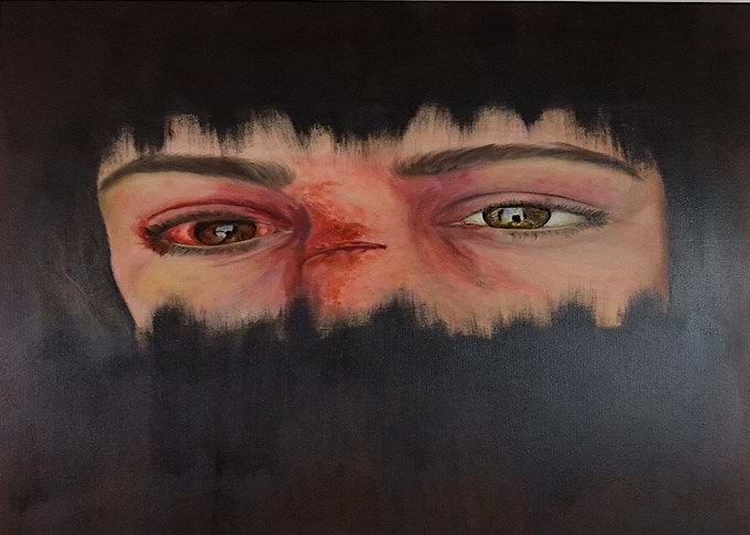 busted eye