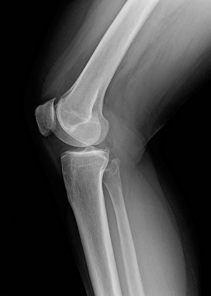 Xray of knees