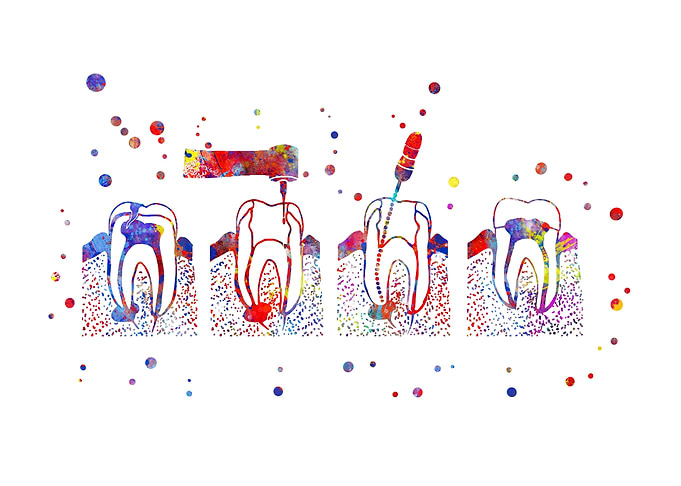 The root canal therapy