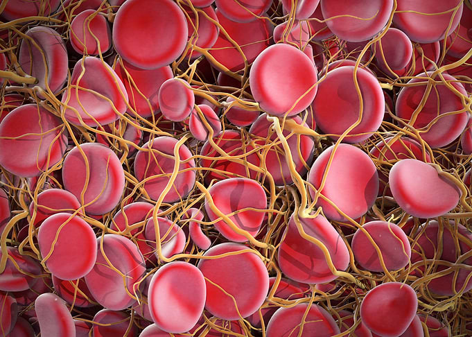 Blood Clot