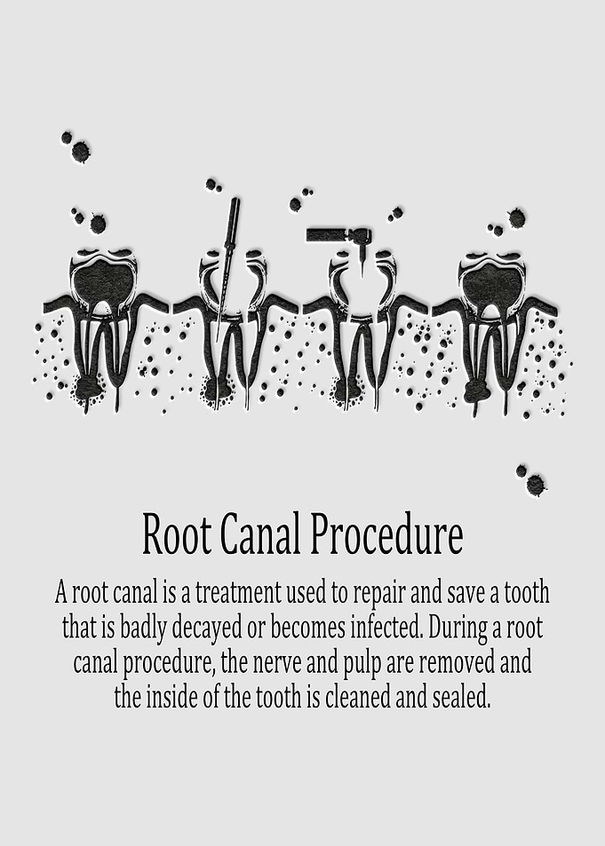 Root Canal Procedure