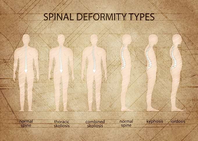Spine deformity