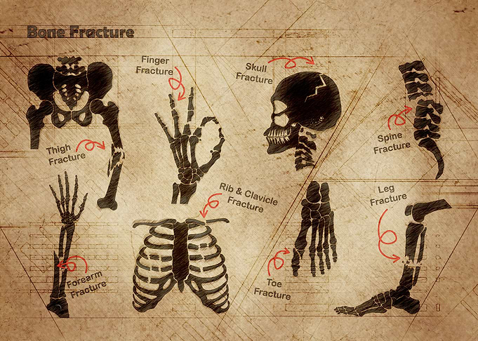 Bone Fracture