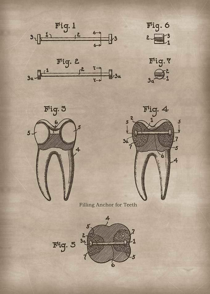 Filling Anchor for Teeth