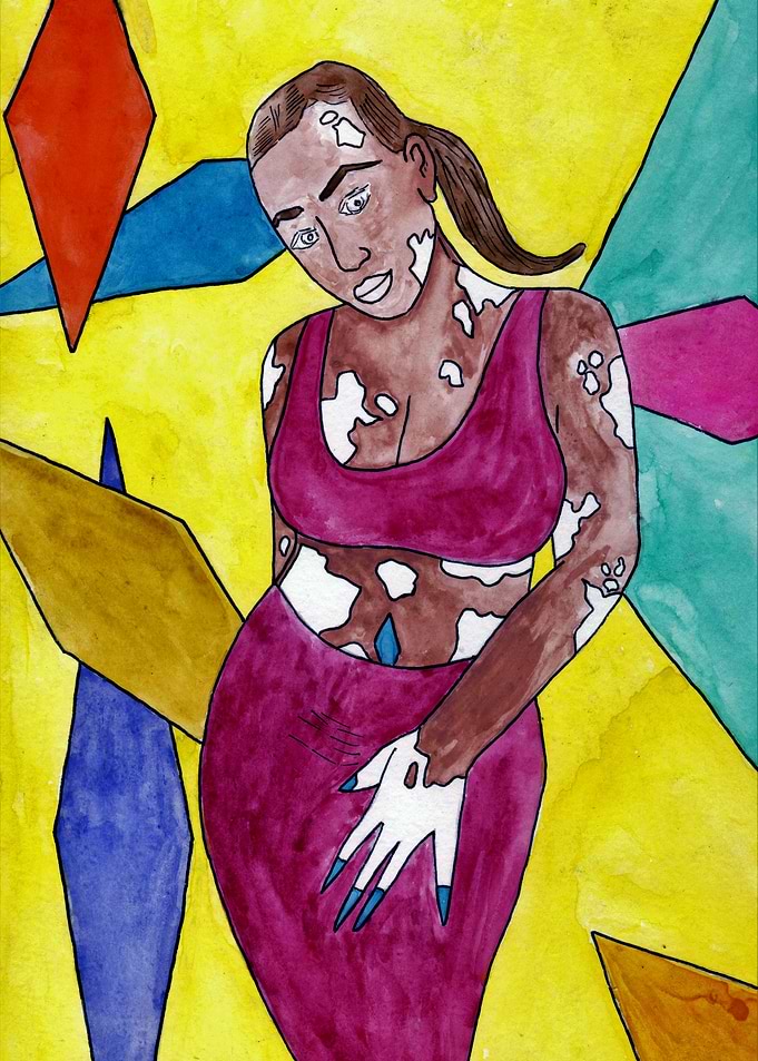 Vitiligo