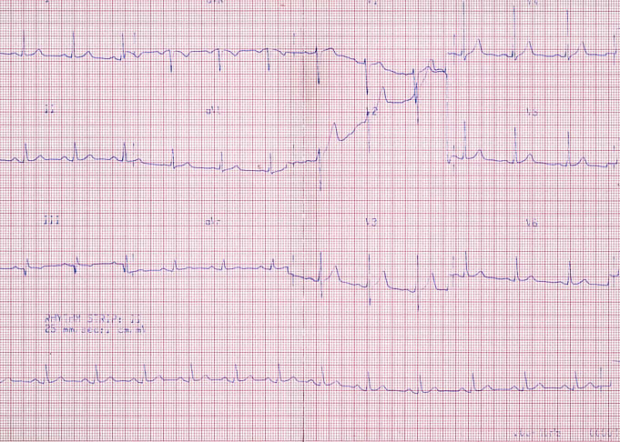 ECG real chart