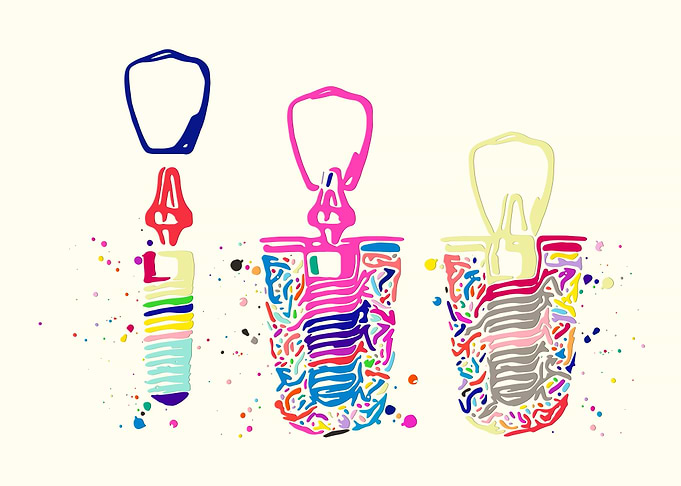 Dental Implant