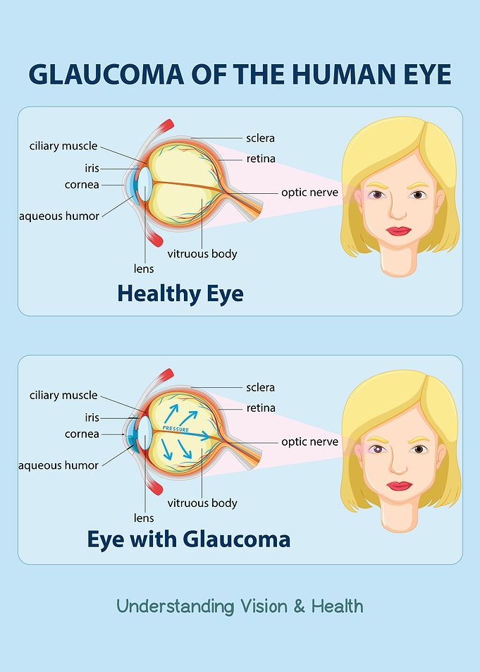 Glaucoma: Healthy Eye vs. Affected Eye