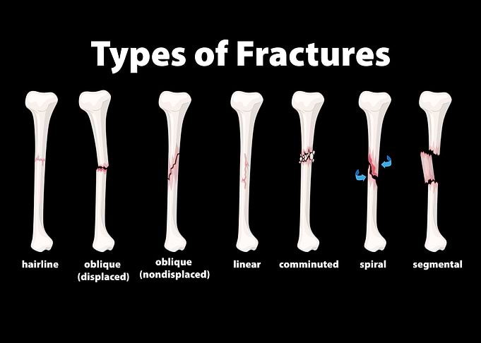 Types of Bone Fractures Illustration