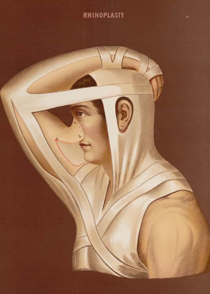 Vintage Rhinoplasty Illustration