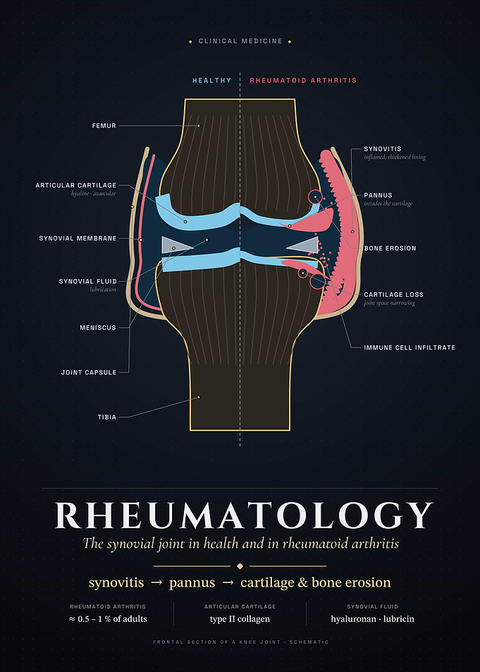 Rheumatology: Healthy Joint vs Rheumatoid Arthritis