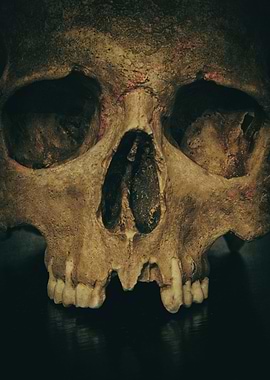 Male skull with missing teeth