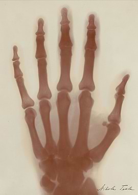 Nikola Tesla's Hand X-ray