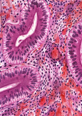 Uterus 'Piano key appearance'