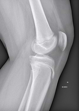 Knee X-ray