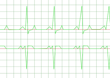 Normal Heart Rhythm Normal Heart Rhythm electrocardiogr ...