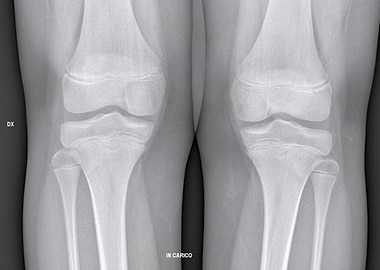 X-ray of Knees